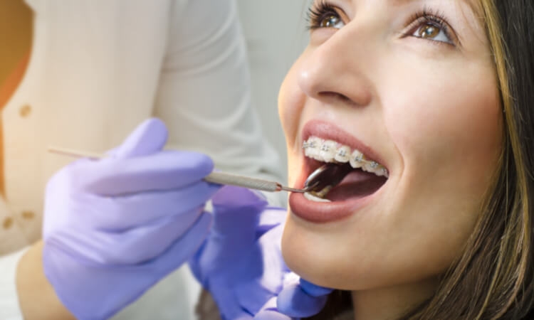 Wyciągi ortodontyczne